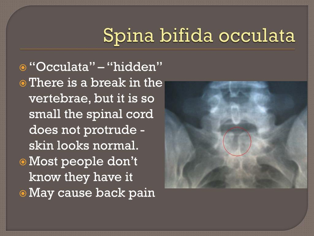 Ppt Spina Bifida Powerpoint Presentation Free Download Id 2030109