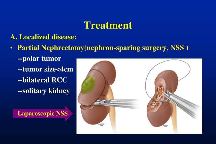 PPT - Renal Cell Carcinoma PowerPoint Presentation - ID:2034977