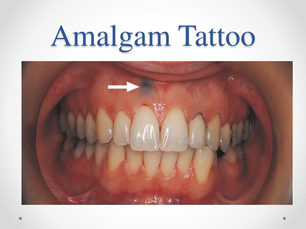 Acute Pain of the Trigeminal Nerve Due to Amalgam in the Mandibular Canal:  A Case Report