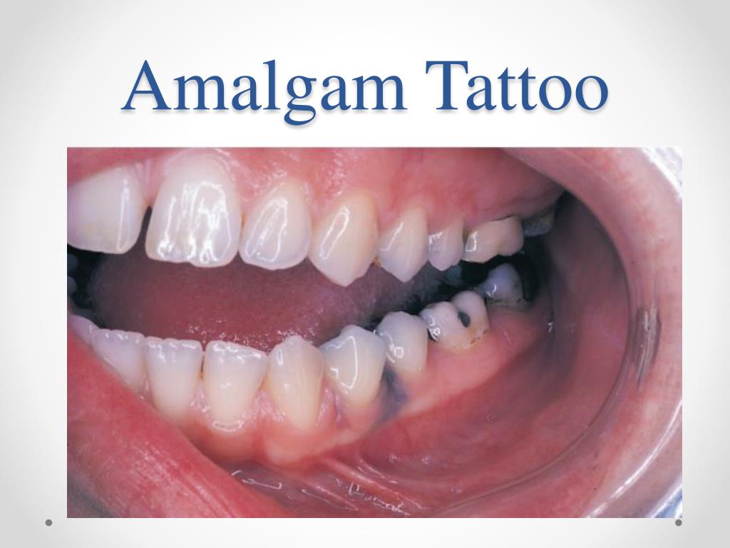 Treatment of the amalgam tattoo in the esthetic zone - Mathews - 2020 -  Journal of Esthetic and Restorative Dentistry - Wiley Online Library
