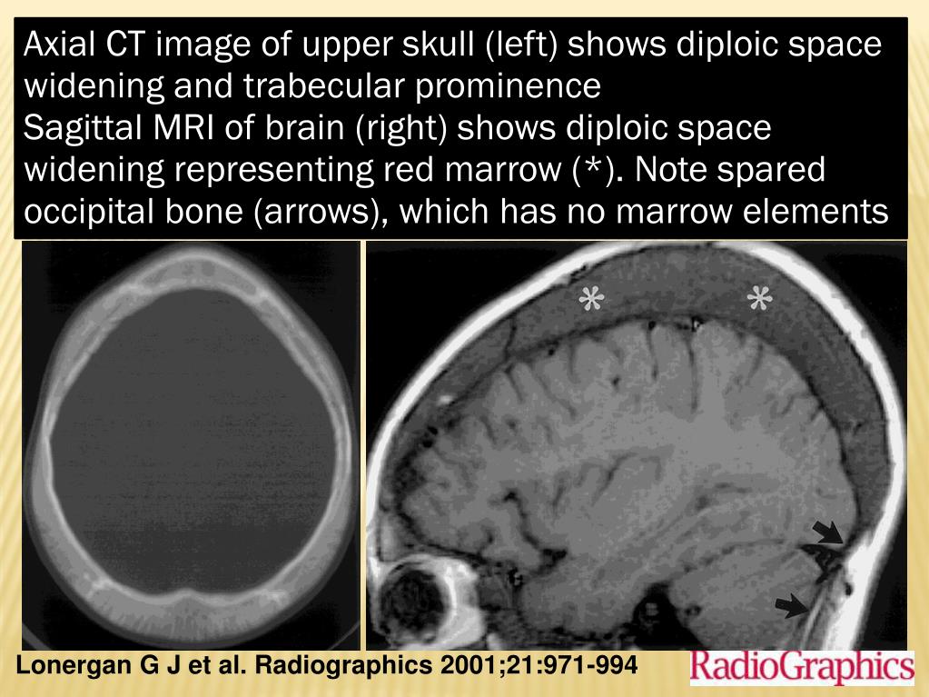PPT RADIOLOGY of HEMATOPOIETIC DISORDERS DR. SAJJAD HUSSAIN ASSISTANT