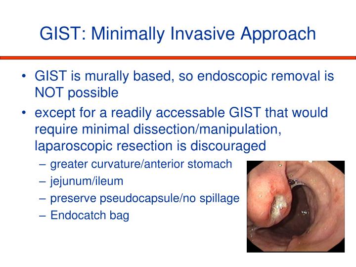 PPT The Surgeon’s Role in the Management of Gastrointestinal Stromal