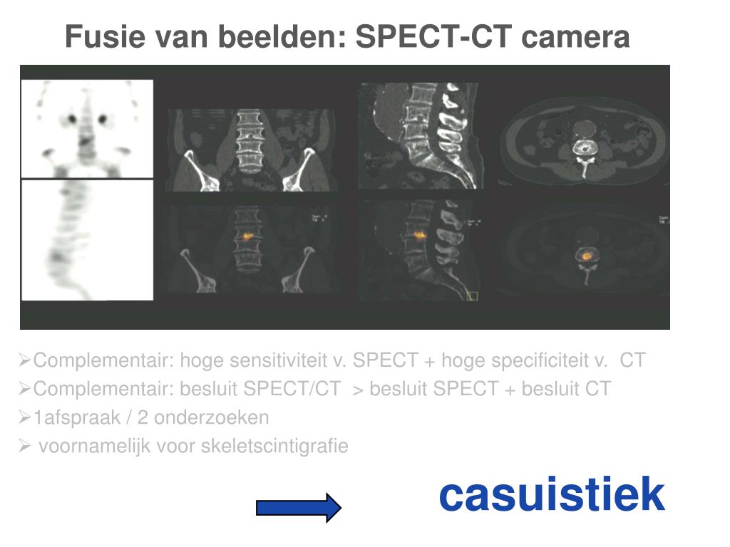 PPT - Meerwaarde van SPECT-CT bij skeletscintigrafie PowerPoint ...