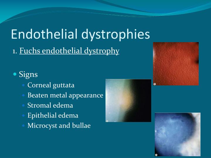 Fuchs Endothelial Dystrophy Histology The Pathophysiology Of Fuchs'