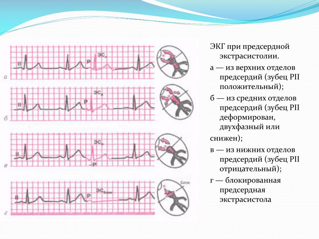 Ощущаю экстрасистолы - найдено 79 картинок