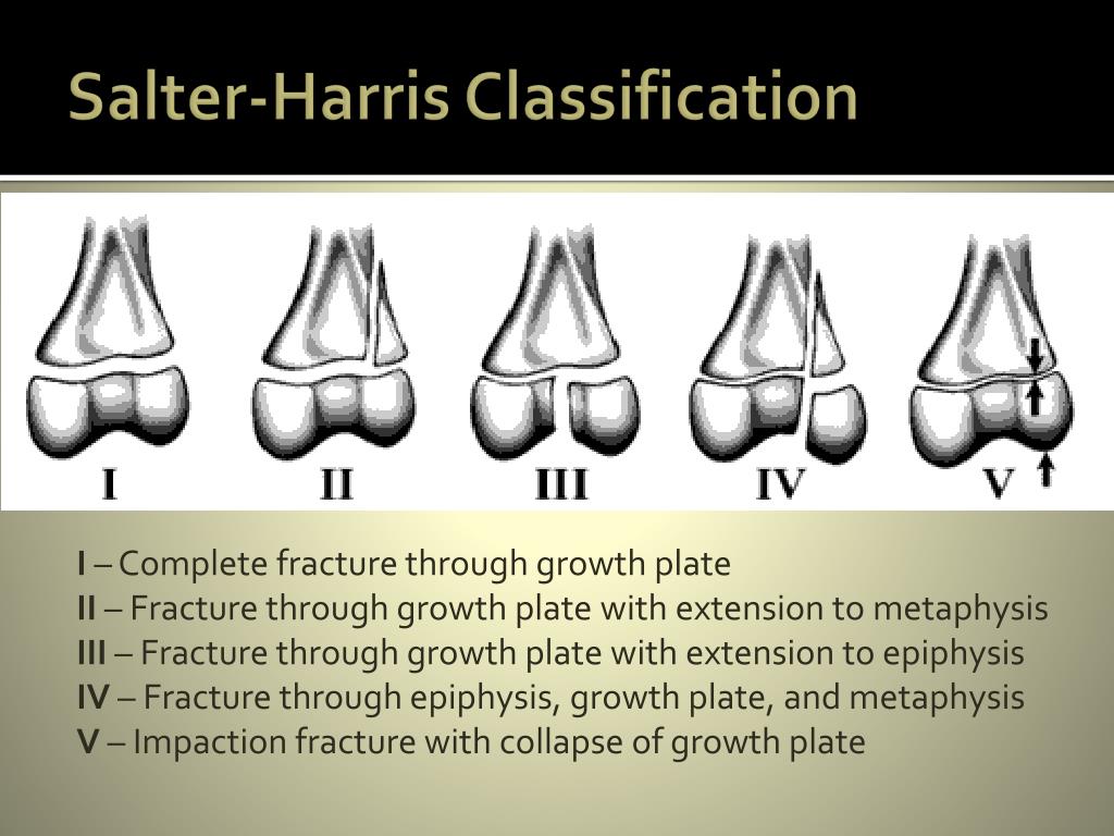 salter harris fracture classification salter harris fracture classification