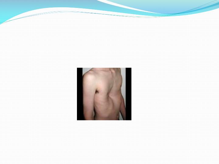 PPT CHEST WALL DEFORMITIES PowerPoint Presentation ID2051060