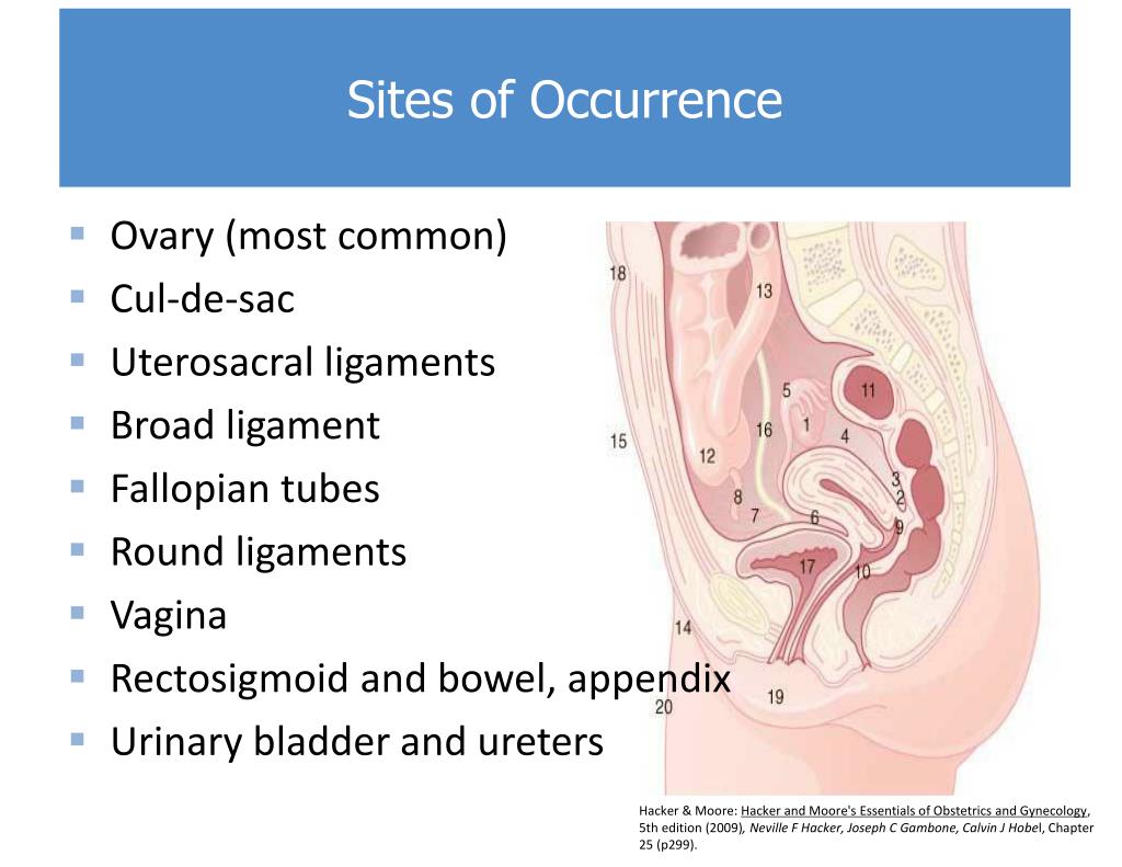 PPT Endometriosis PowerPoint Presentation Free Download ID 2054805 ppt-endometriosis-powerpoint-presentation-free-download-id-2054805