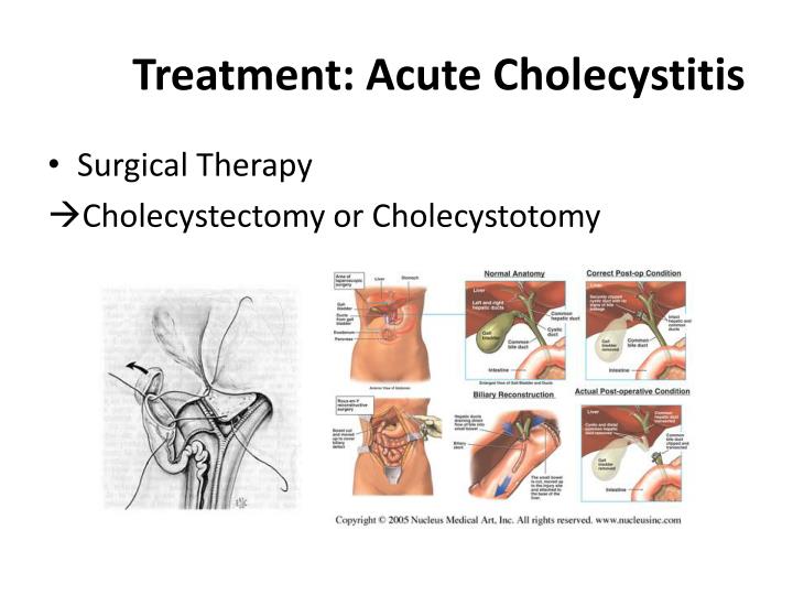 PPT - Limey (Milk of Calcium) Bile PowerPoint Presentation - ID:2055108