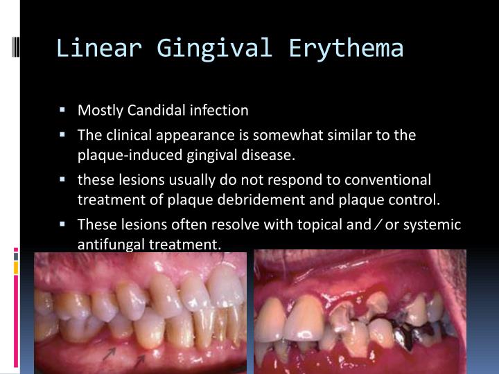 PPT Periodontitis as a manifestation of systemic diseases PowerPoint
