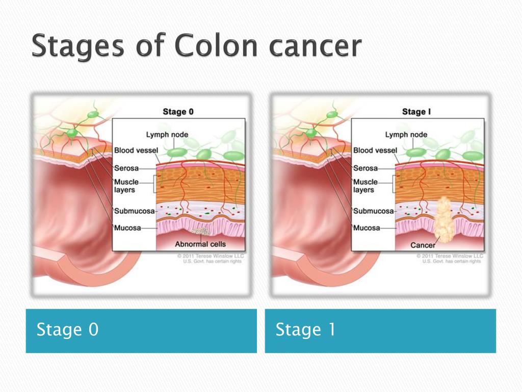 Ppt Colon Cancer Powerpoint Presentation Free Download Id2063409