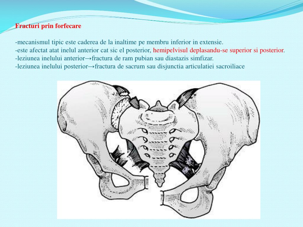 PPT - Fracturile de pelvis PowerPoint Presentation, free download -  ID:2063583