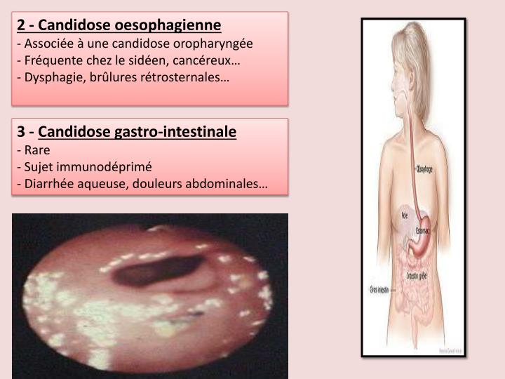 PPT - Candidoses PowerPoint Presentation - ID:2066116