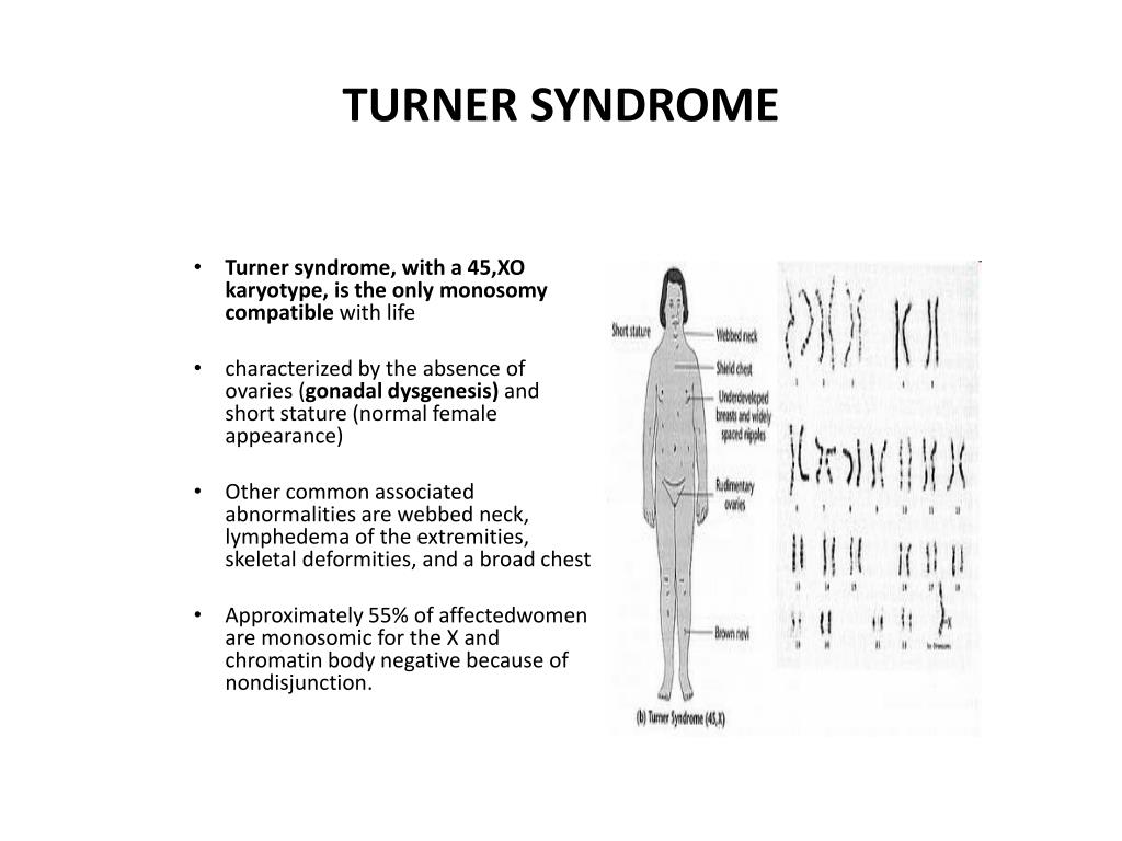 Which Syndrome Is Characterized By The Xo Chromosome Abnormality Blog