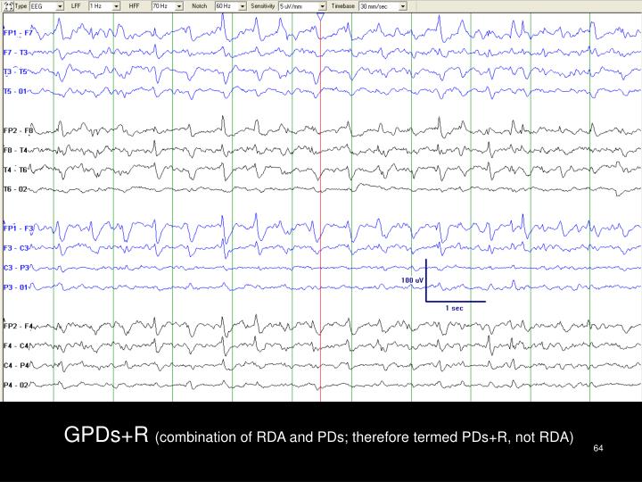 PPT - American Clinical Neurophysiology Society’s Standardized Critical ...
