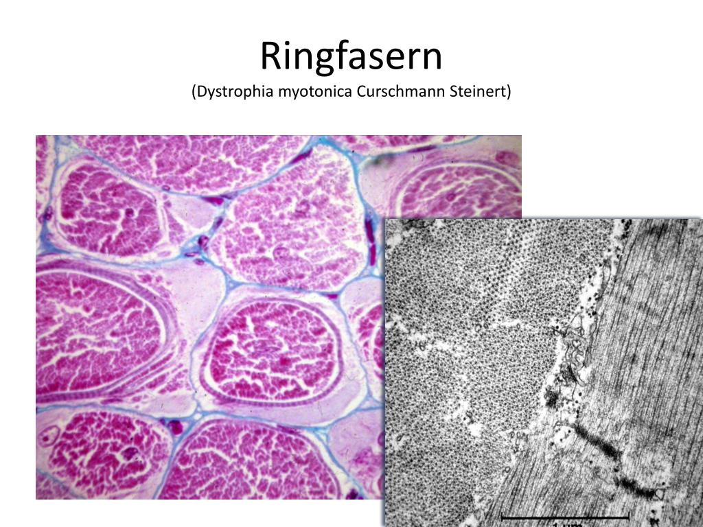 PPT - Muskeldystrophien beim Erwachsenen PowerPoint Presentation, free ...