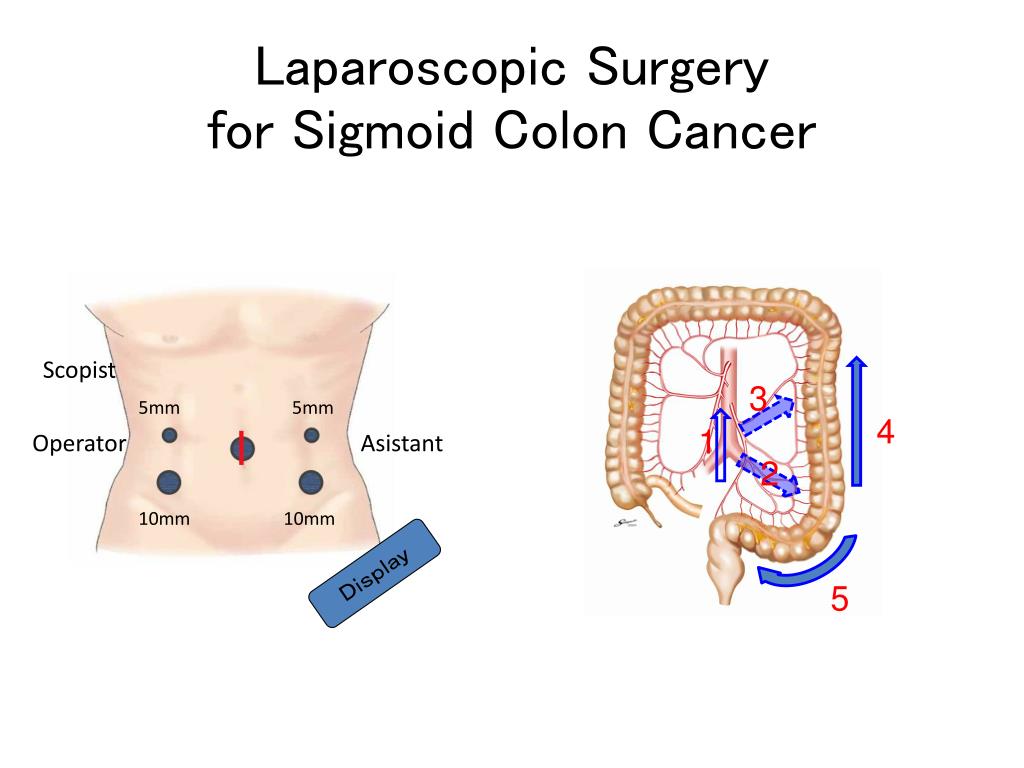 Ppt Laparoscopic Surgery For Colon Cancer In Japan Powerpoint
