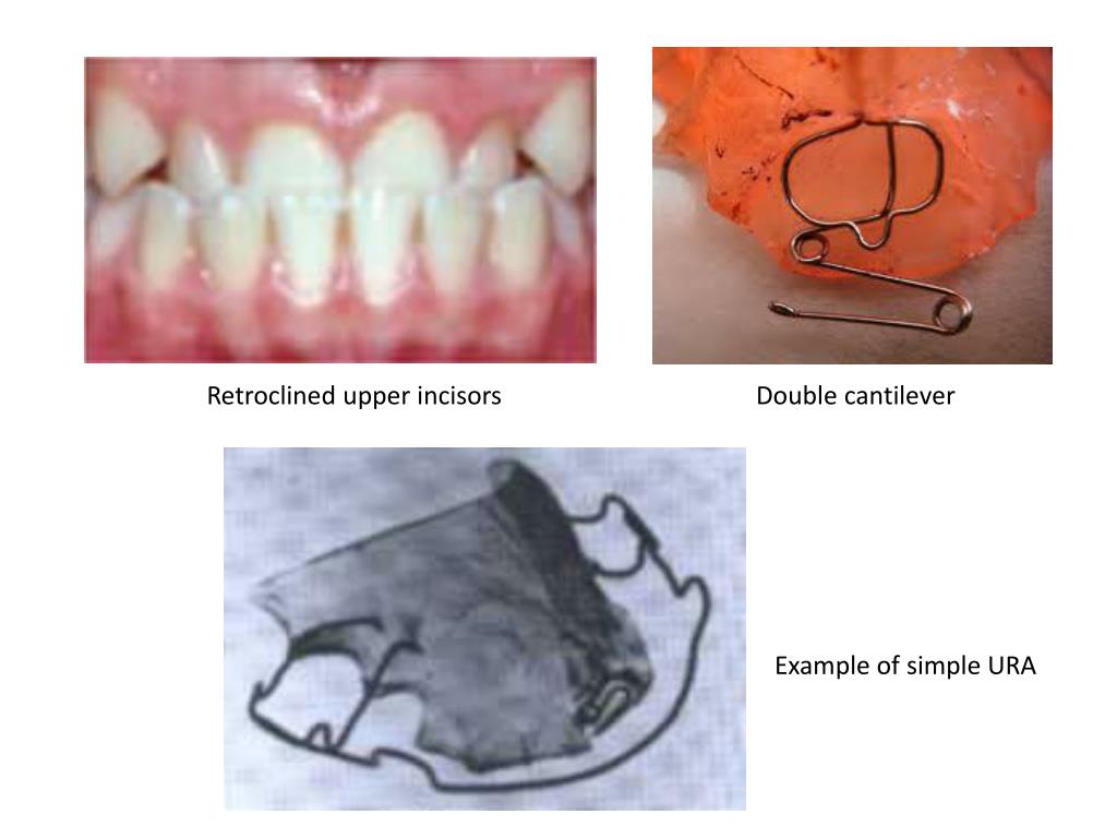 PPT - Hawley’s retainer & other URA PowerPoint Presentation, free ...