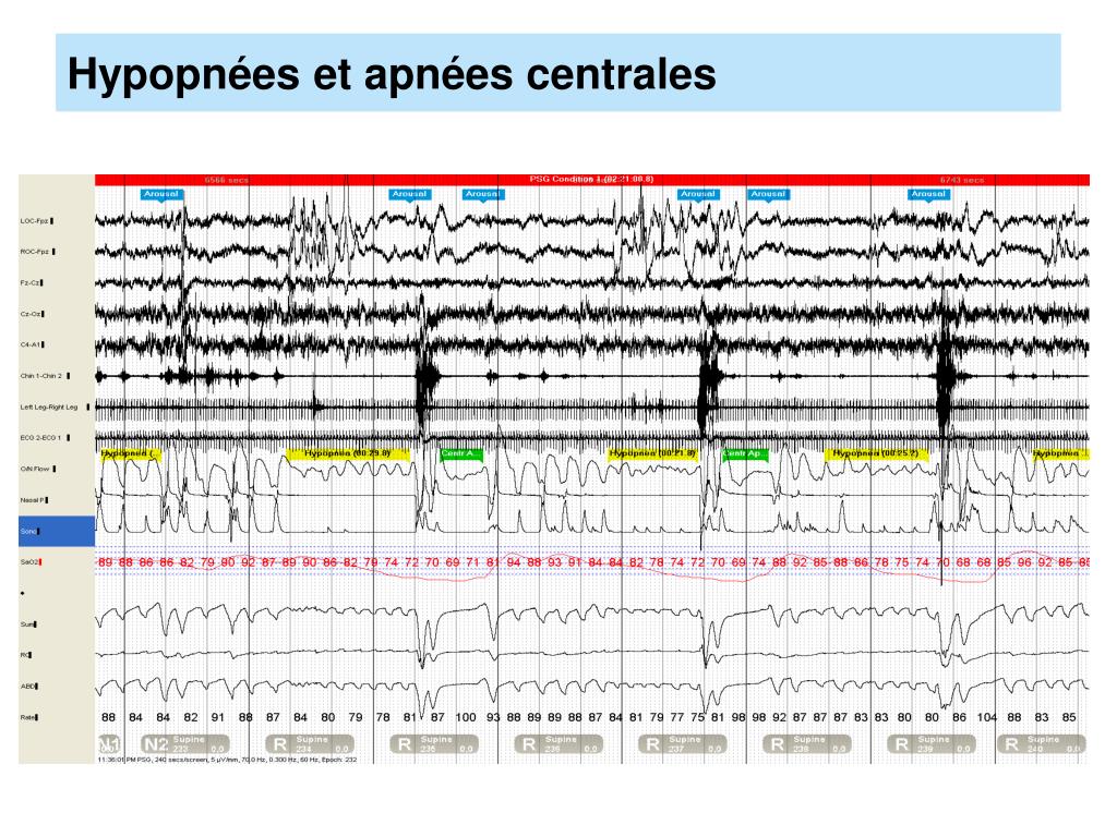 PPT - Syndrome d’apnées du sommeil chez le sujet âgé PowerPoint ...
