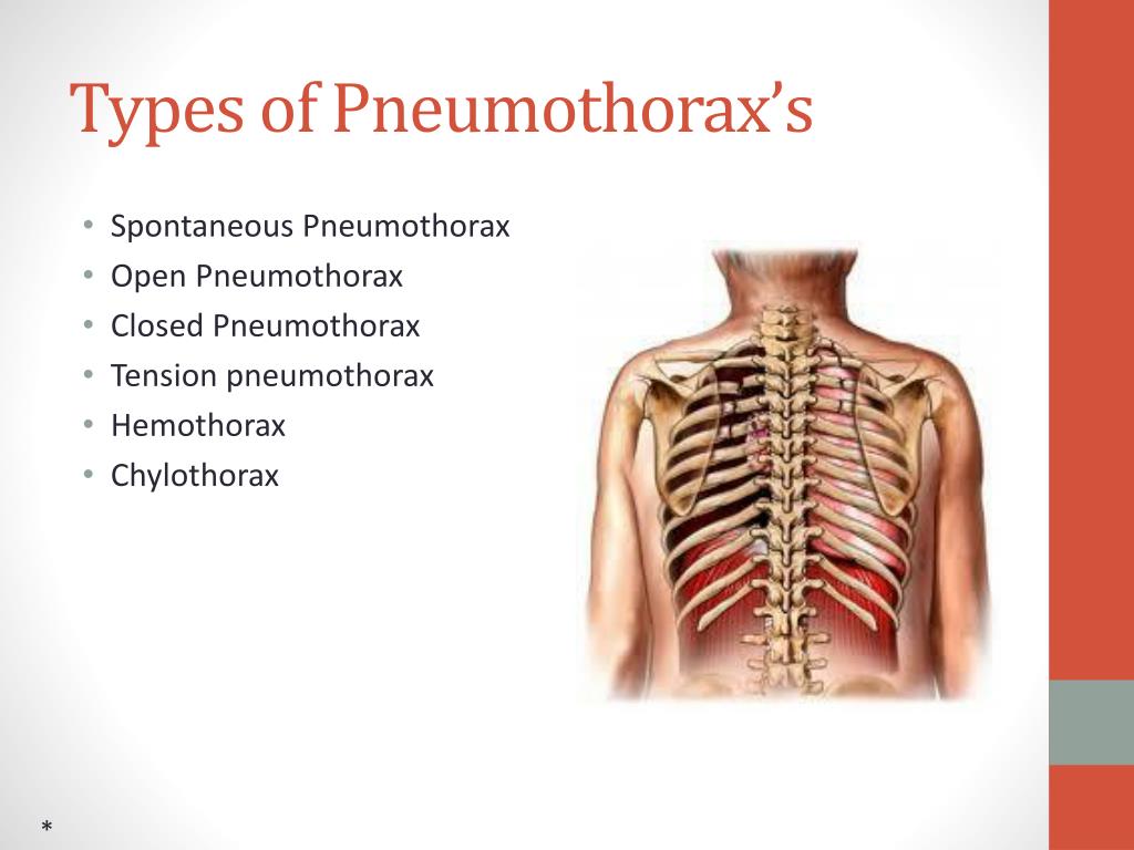 Different Types Of Pneumothorax