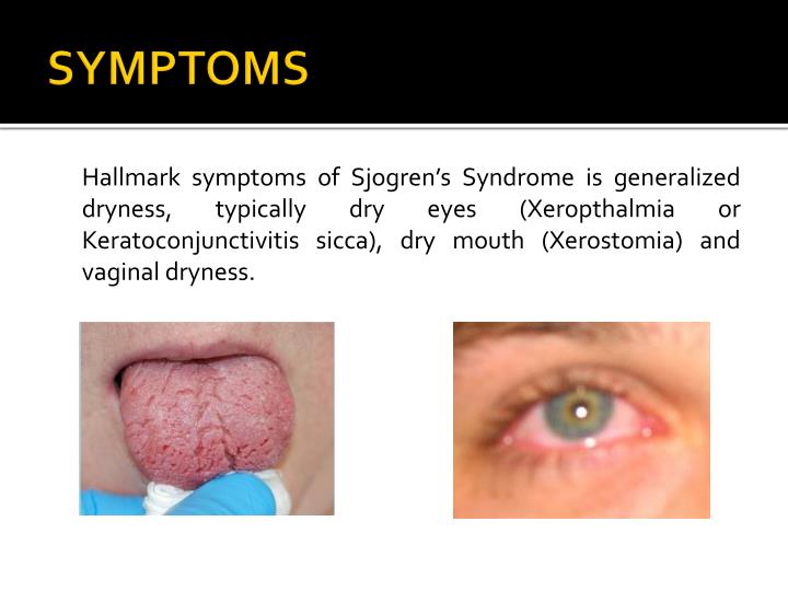 Ppt Sjogrens Syndrome Powerpoint Presentation Id2089181