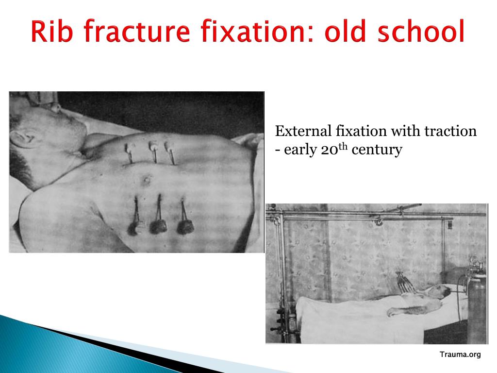 PPT - Novel Treatments of Rib Fractures: Hype or Future? PowerPoint ...