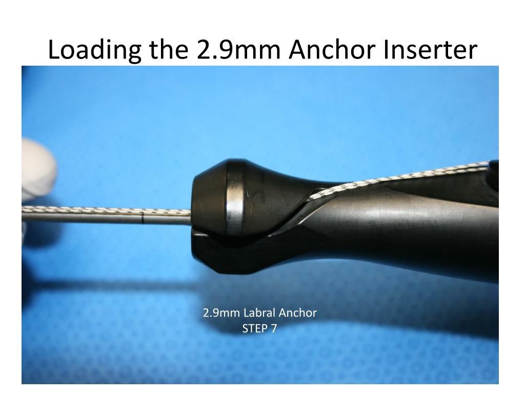 guideliner balloon anchor technique guideliner balloon anchor technique