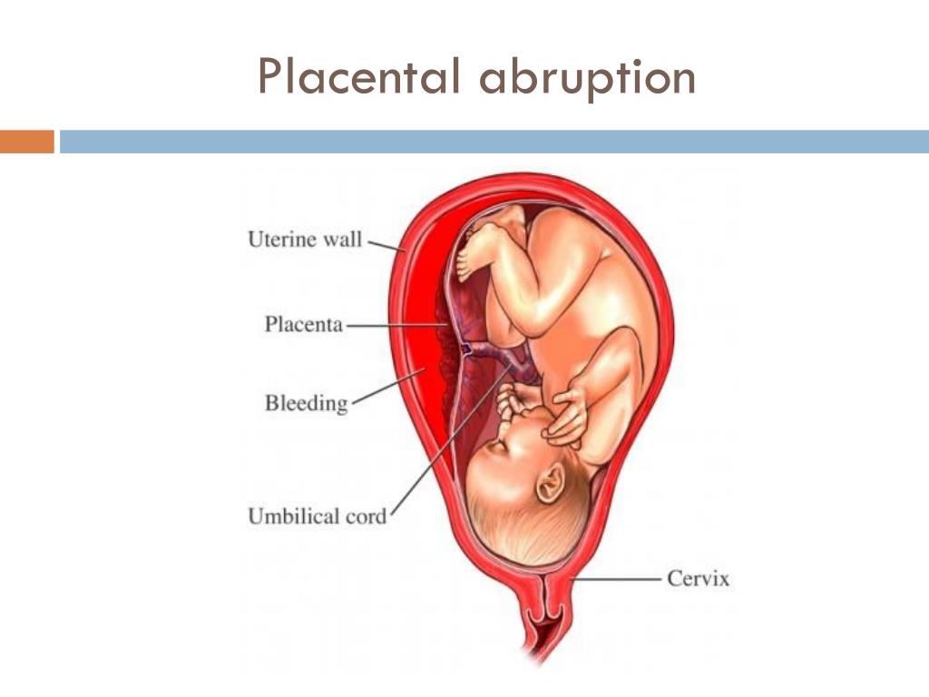 Descolamento prematuro da placenta sintomas de diabetes Descolamento prematuro da placenta sintomas de diabetes ctrader forex magnates summit