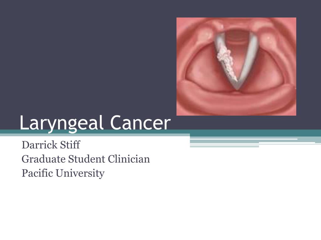 PPT - Laryngeal Cancer PowerPoint Presentation, free download - ID:2098953