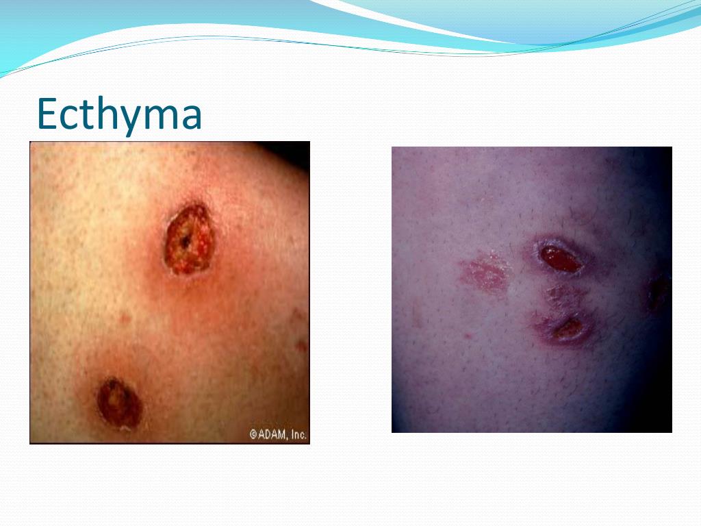 Ecthyma Impetigo Ecthyma Impetigo