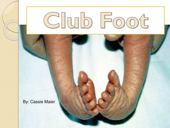 club foot n.