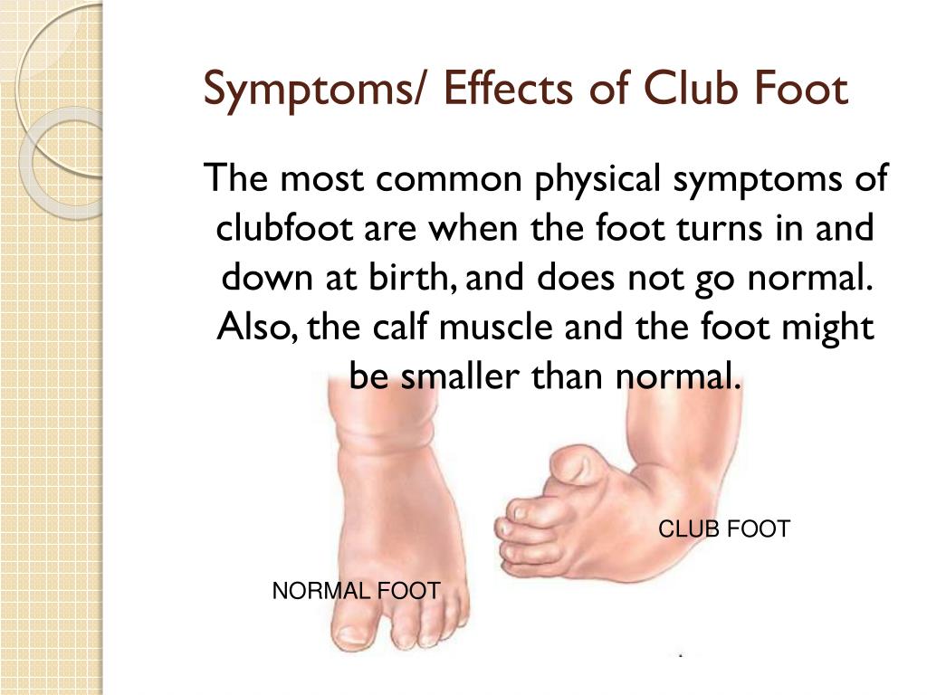 Ppt Club Foot Powerpoint Presentation Free Download Id