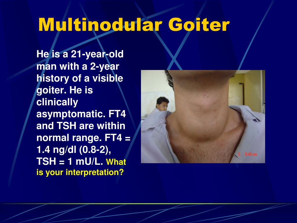 PPT Simple Nontoxic Goiter Diffuse And Multinodular PowerPoint 