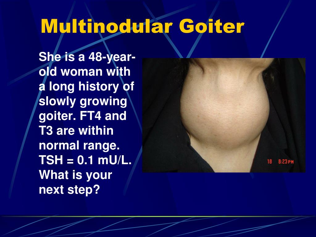 Multinodular goiter