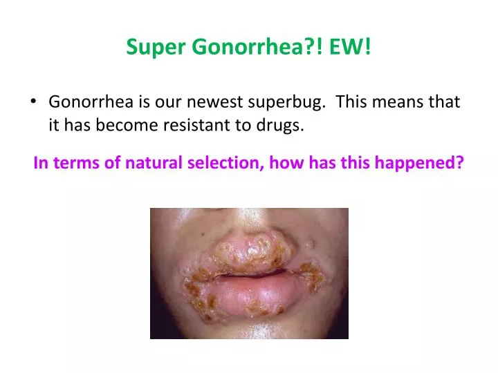 super-gonorrhea-ew-n.jpg