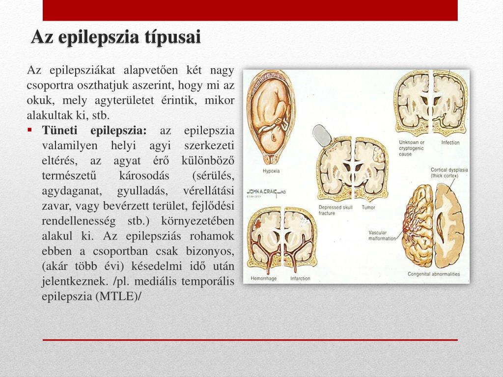 epilepszia és látás)