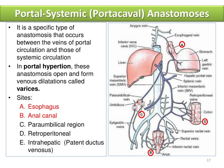 portacaval anastomosis