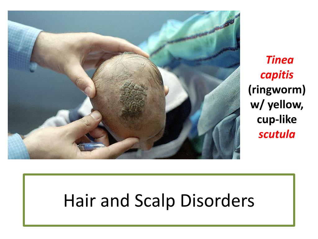 PPT - Hair and Scalp Disorders PowerPoint Presentation, free download - ID:2118987 PPT - Hair and Scalp Disorders PowerPoint Presentation, free download - ID:2118987