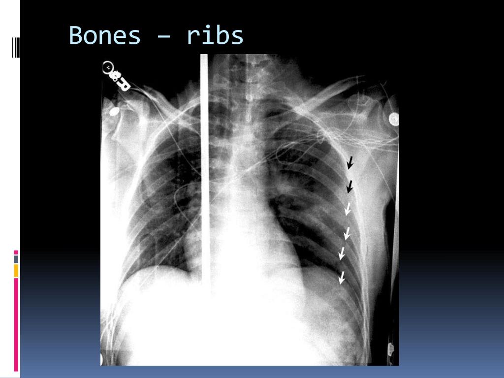 PPT How To Read X Ray Chest PowerPoint Presentation Free Download 