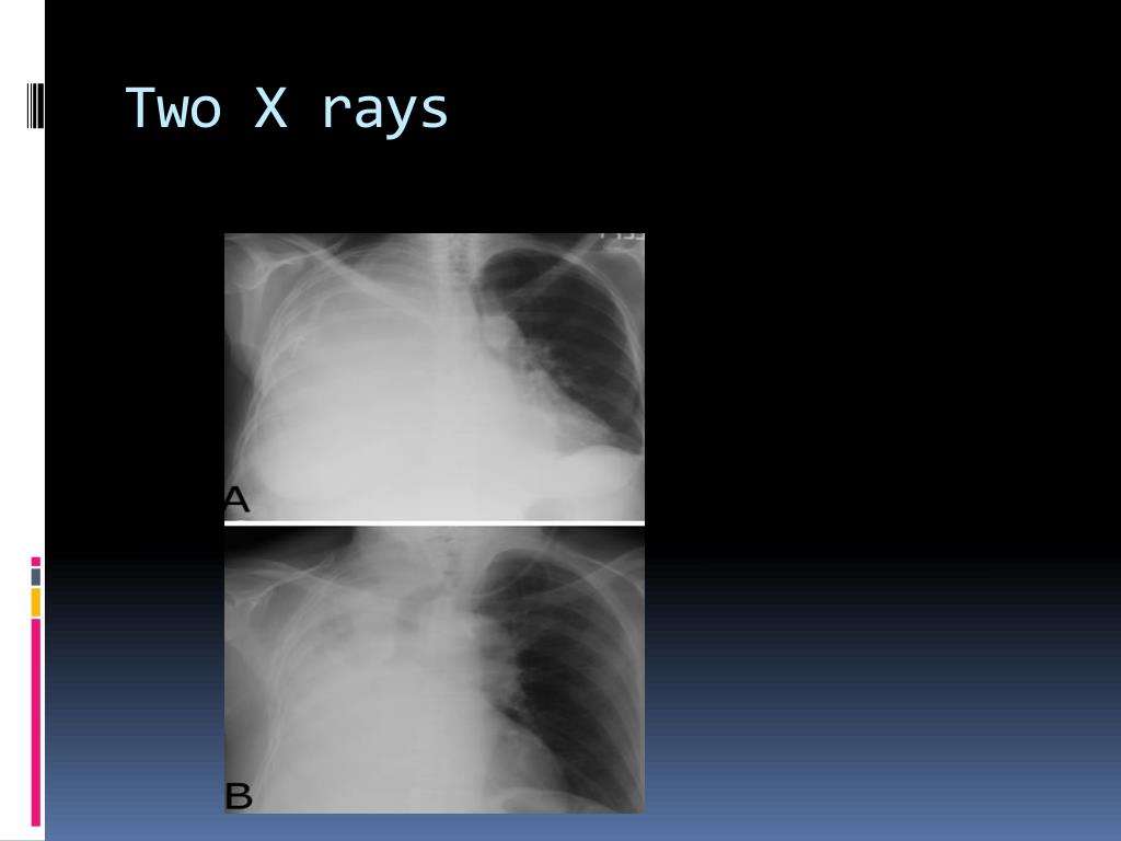 PPT How To Read X Ray Chest PowerPoint Presentation Free Download 