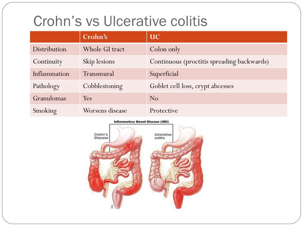 Ulcerative Colitis Vs Crohn's - Pin by Michele Gunn Mitchell on Crohns