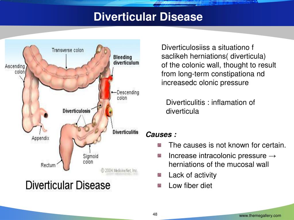 Diverticulitis nhs diet sheet