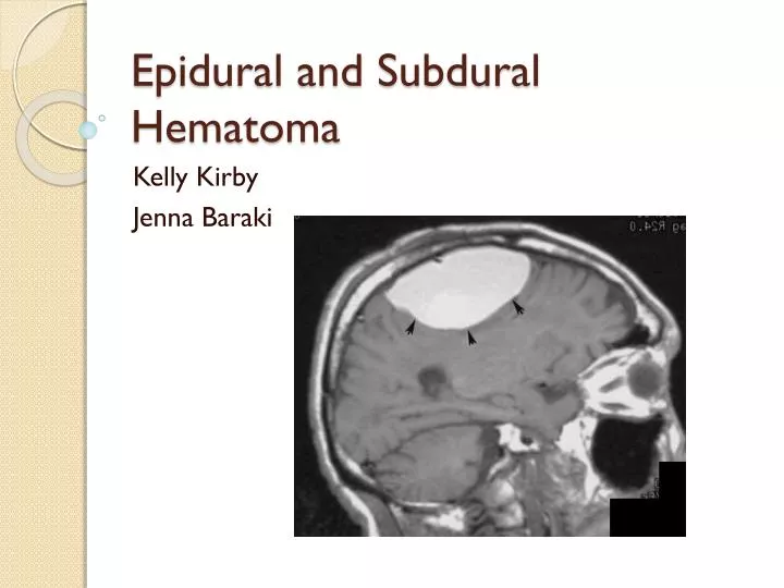 Epidural Vs Subdural Hematoma