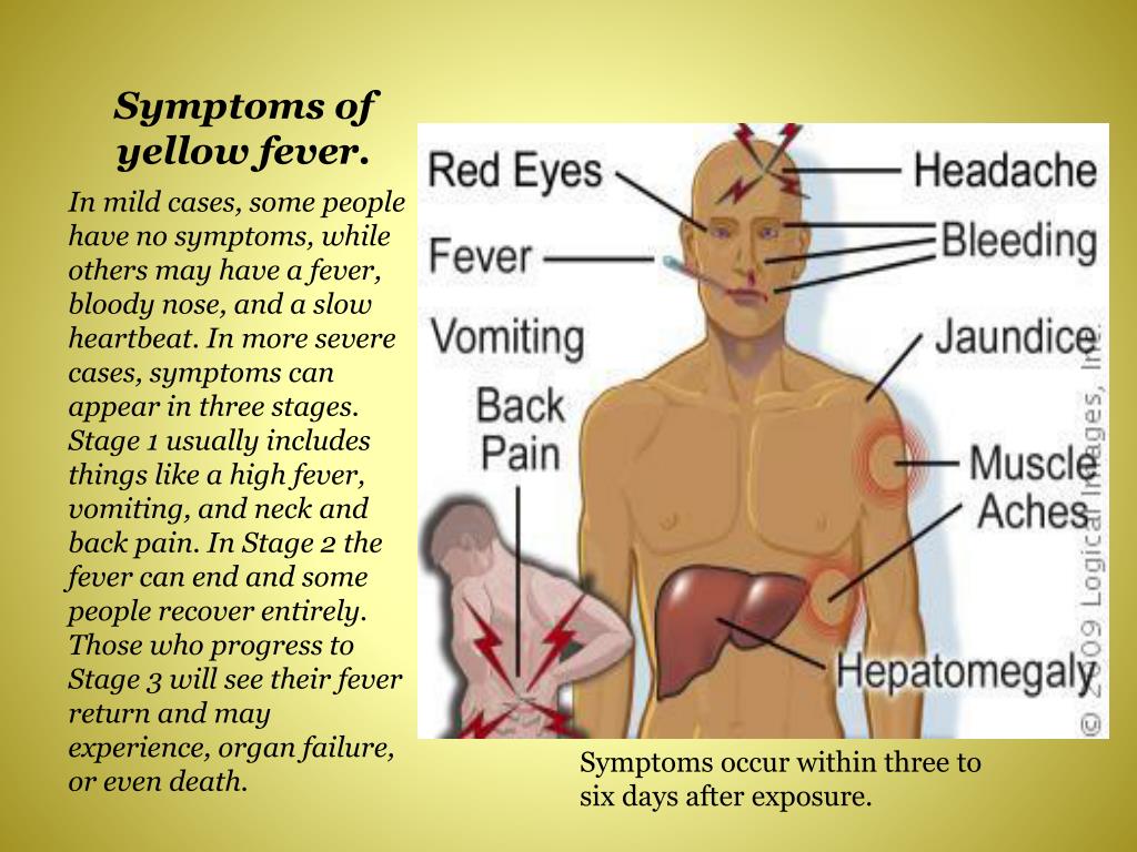 PPT - Yellow Fever PowerPoint Presentation, free download - ID:2122902