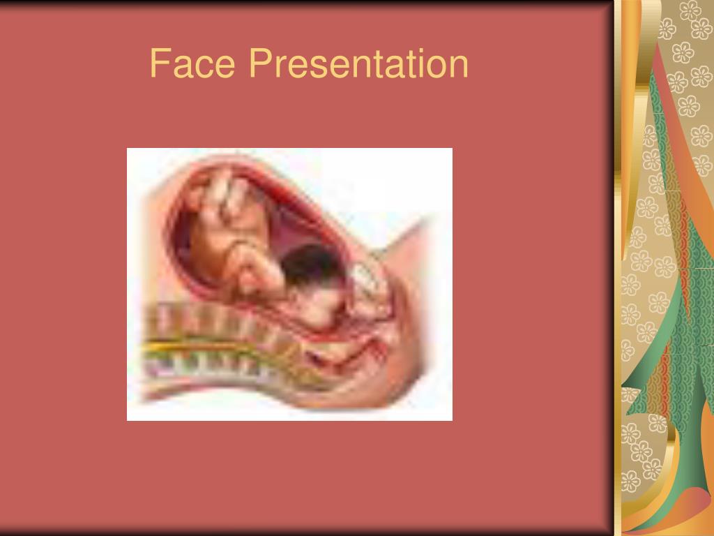 face presentation at birth