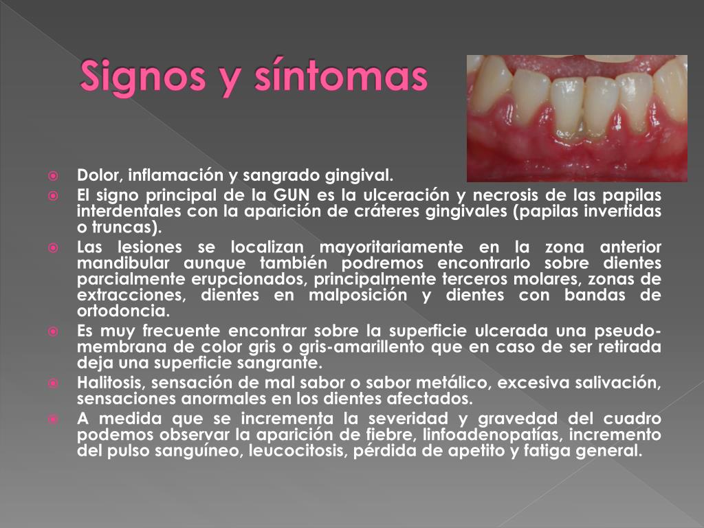 signos y sintomas gingivitis signos y sintomas gingivitis