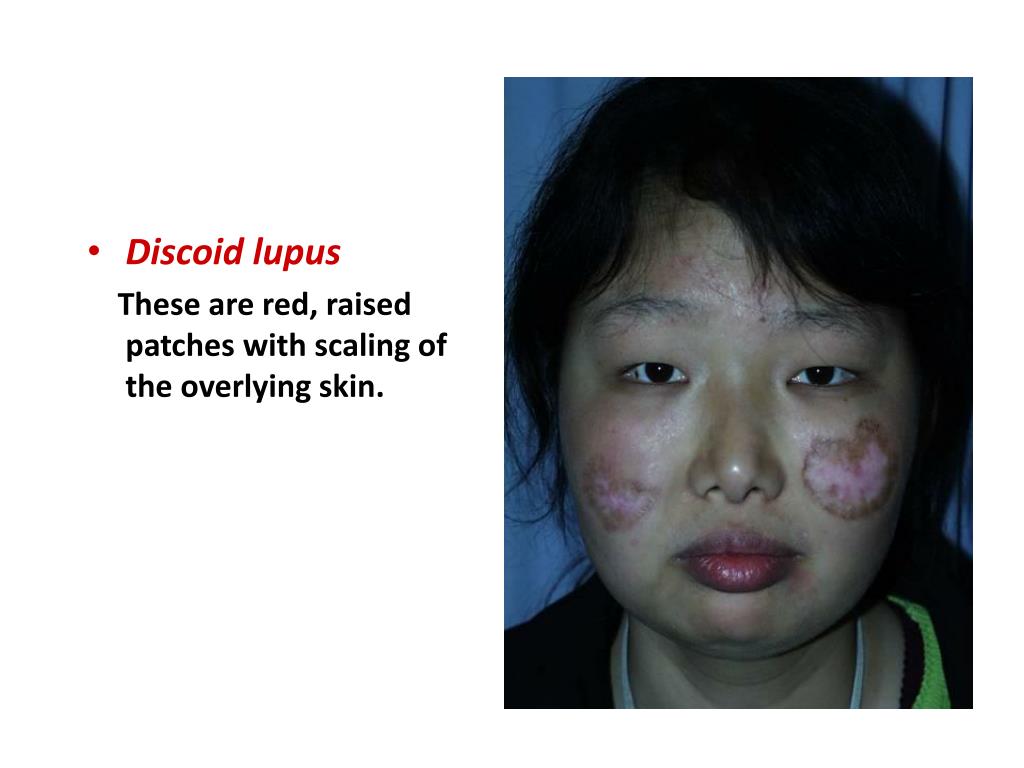 PPT - SKIN MANIFESTATIONS IN RHEUMATIC DISEASES AROMA 2011 PowerPoint ...