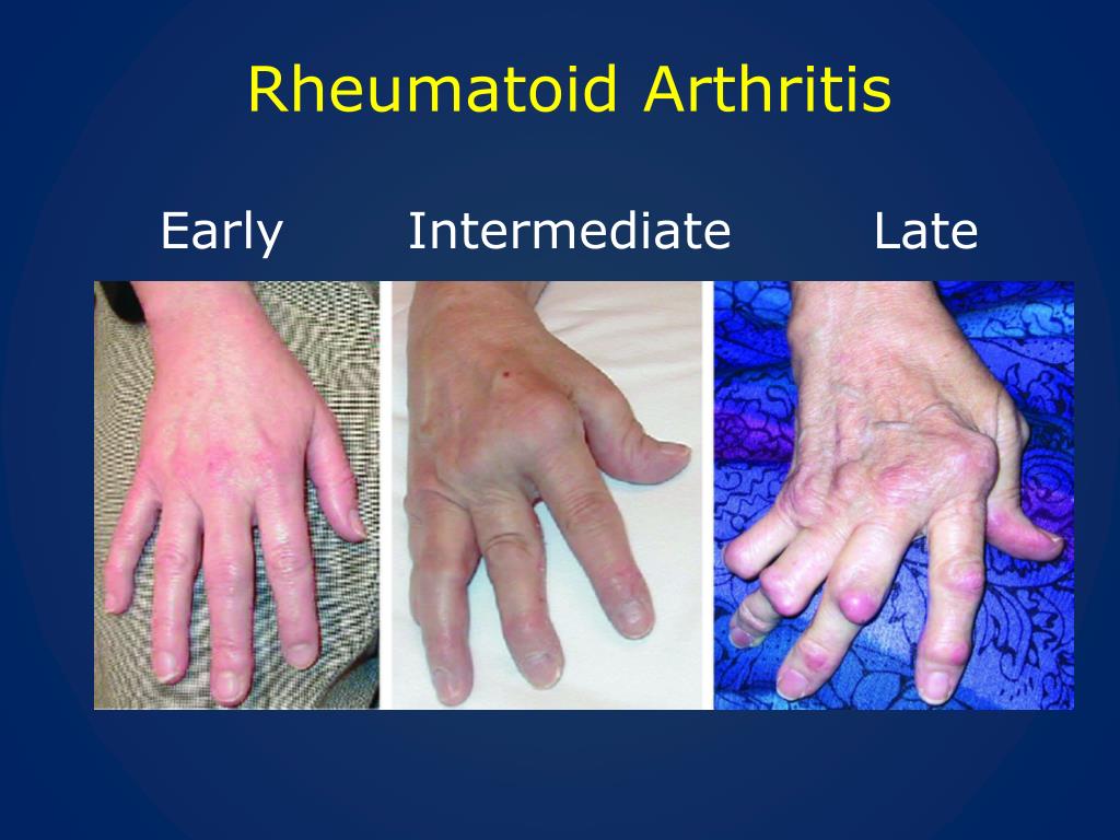 Ppt Rheumatoid Arthritis Update Powerpoint Presentation Free Download Id2137251 8305