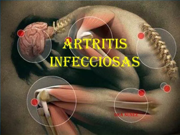 artritis bacteriana sintomas