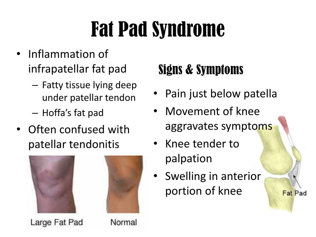 Knee Fat Pad Syndrome